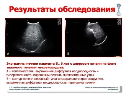 Заключение узи диффузных изменений печени