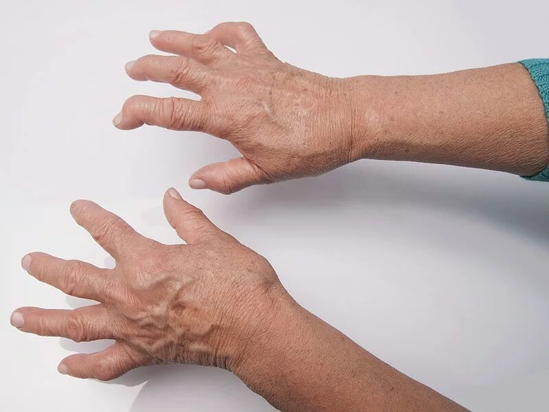 ARTHRITIS GONE!!!! - YouTube