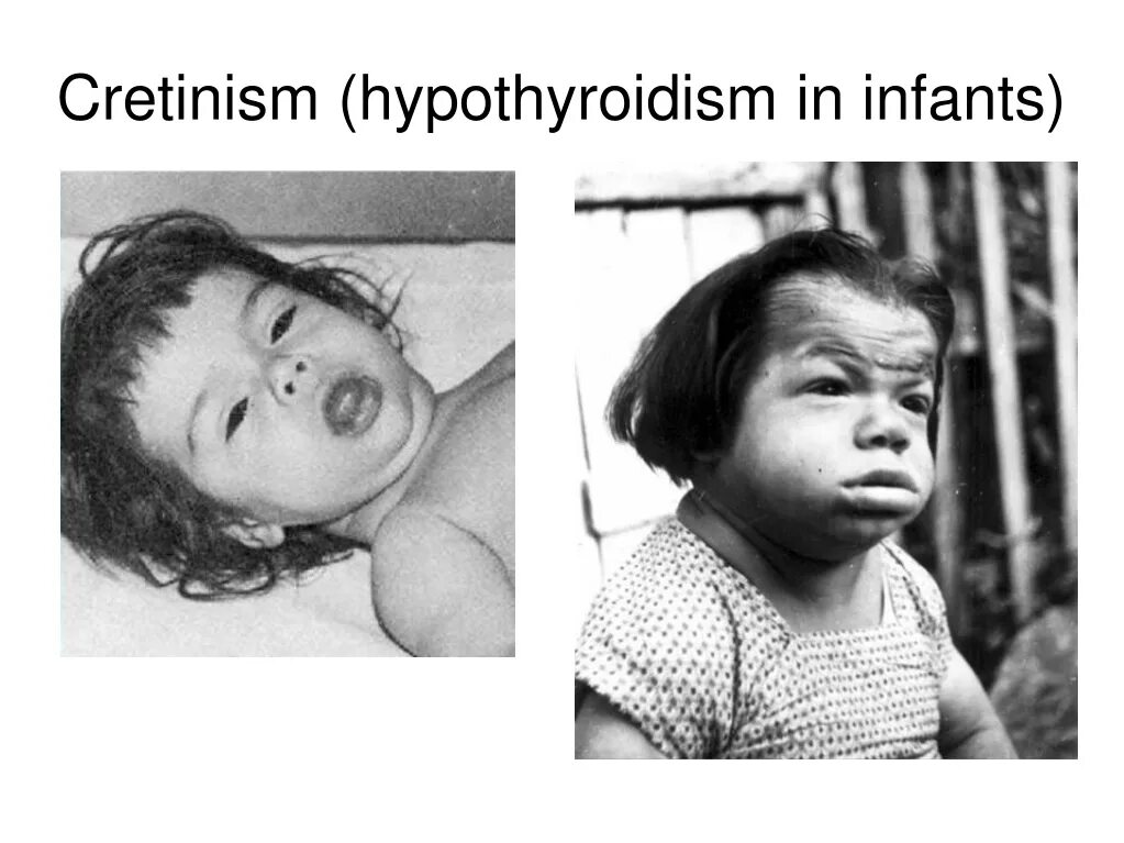 топографический топографический кретинизм. критинизм это. эндемический кретинизм. кретининизм. критинизм это.