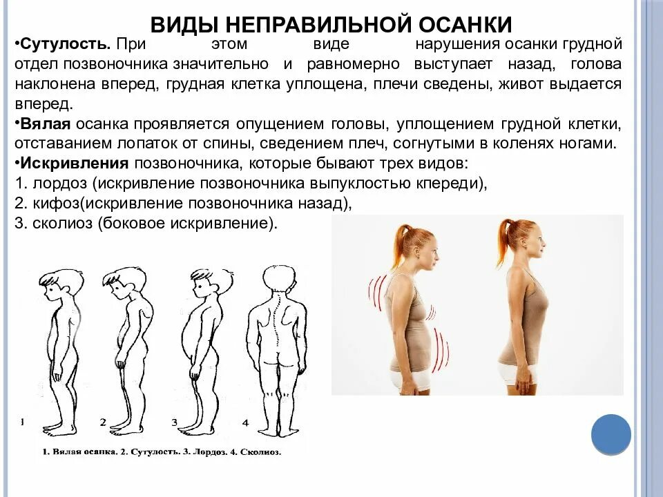 Нарушение осанки код. Типы неправильной осанки. неправильная осанка. типы нарушения осанки человека. типы деформаций осанки.
