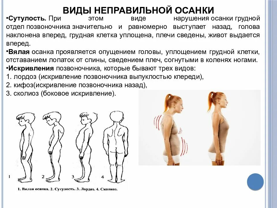 Изгиб кпереди. Нарушение осанки. Виды неправильной осанки. Нарушенная осанка. Неправильная осанка.