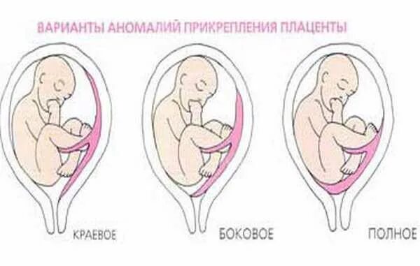 Краевое предлежание плода на 12 неделе беременности. Плацента перекрывает внутренний зев. Предлежание плаценты при беременности. Хорион перекрывает внутренний зев. 13 неделе беременности плацента