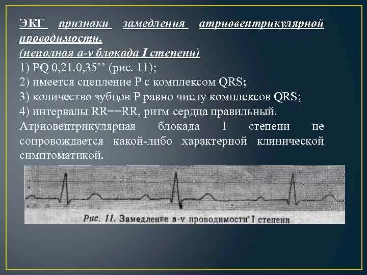 Что означает неполная блокада. Неполная АВ блокада 1 степени. Неполная АВ блокада 1 степени на ЭКГ. Нарушение проводимости АВ блокады. Признаки атриовентрикулярной блокады 1 степени.