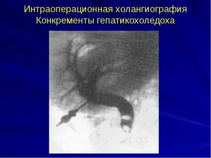 Холангиография
