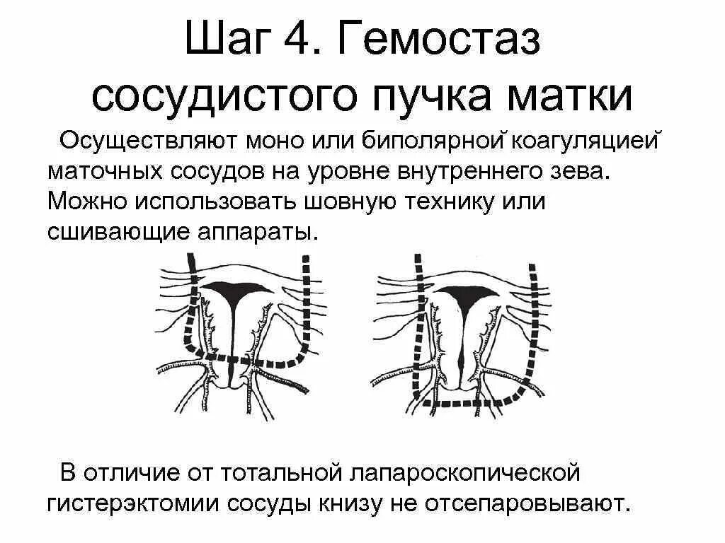 Сосудистый пучок. Сосудистые маточные пучки. Перевязка сосудистых Пучков. Перевязка сосудистых Пучков на матке.