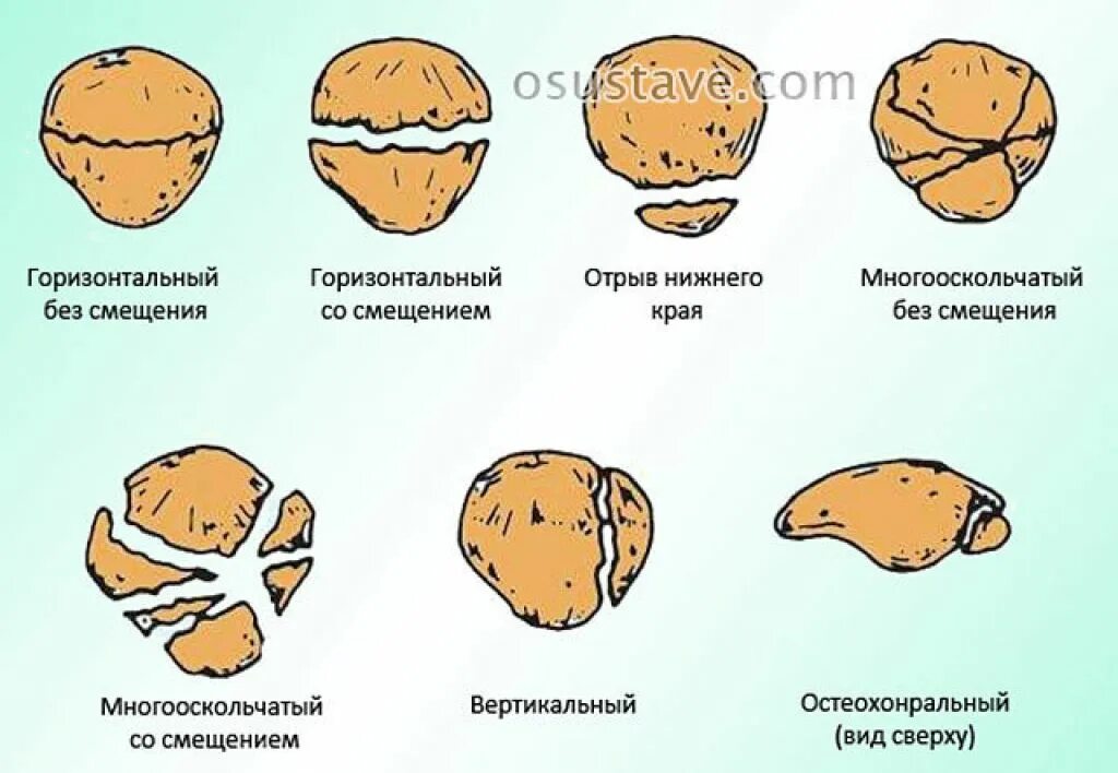 Латерализация надколенника. Оскольчатый перелом надколенника. Перелом Нижнего полюса надколенника без смещения. Многооскольчатый перелом надколенника со смещением. Поперечный перелом надколенника без смещения.