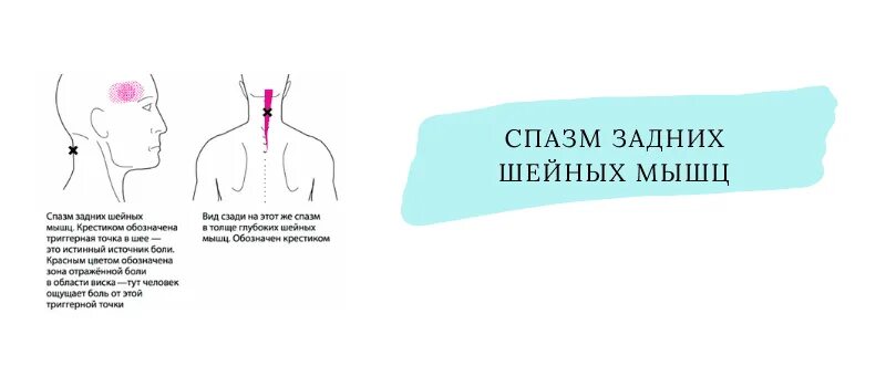 Боль в спине. Шейно-воротниковая зона мышцы. Мышечный спазм в шее. Мышечный спазм в шее. Болит спина и шея.