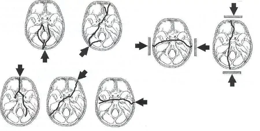 Для перелома основания черепа характерно. Переломы основания черепа передней черепной ямки. Перелом основания черепа ликворея. Перелом среднечерепной ямки. Перелом свода черепа, перелом основания черепа.