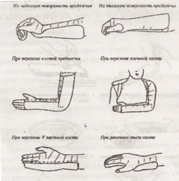Как правильно вставлять пальцы. Гипсовые лангеты техника наложения. Наложение гипсовой лангеты алгоритм. Гипсовая лонгета при переломах стопы. Перелом лучевой кости гипсовая лонгета.