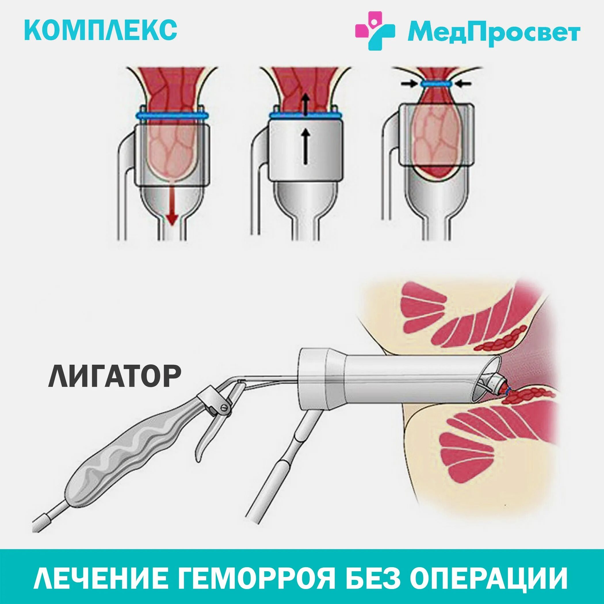 Лечение геморроя чебоксары