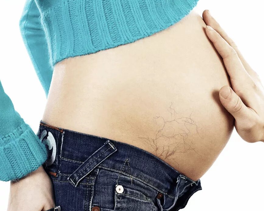 Варикозное расширение вен при беременности. Узелковый полиартериит ливедо. Варикозное расширение вен малого таза. Ретикулярный варикоз вен. Варикозное расширение вен на животе.