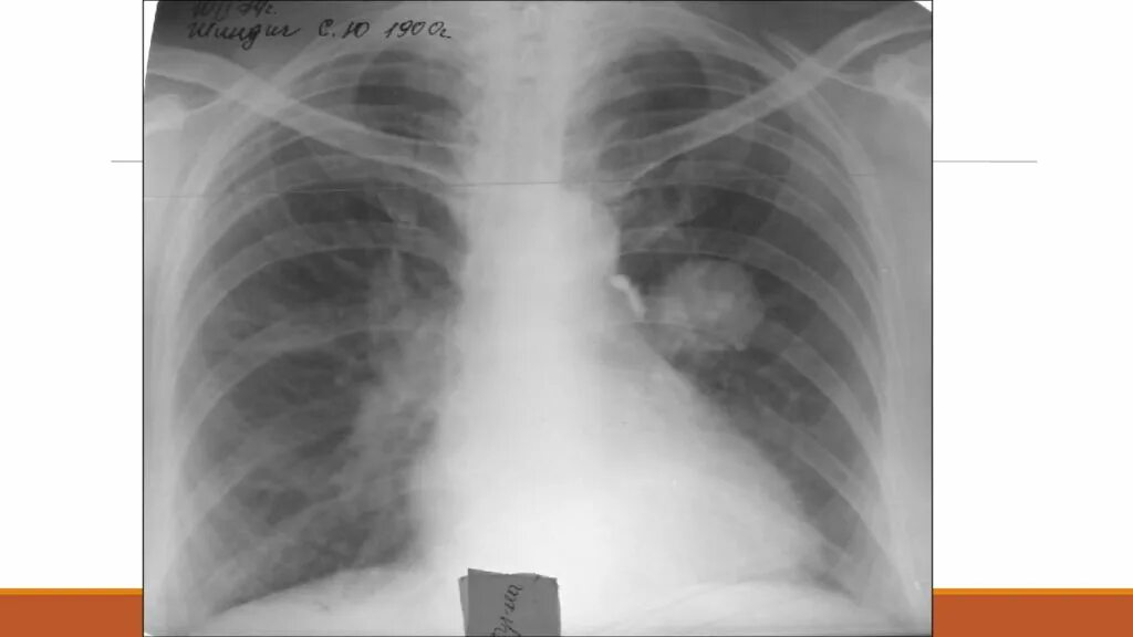 Туберкулема туберкулез легких рентген. Очаговый и инфильтративный туберкулез. Туберкулома легкого на рентгенограмме. Распад туберкуломы. Туберкулома легкого на рентгенограмме.