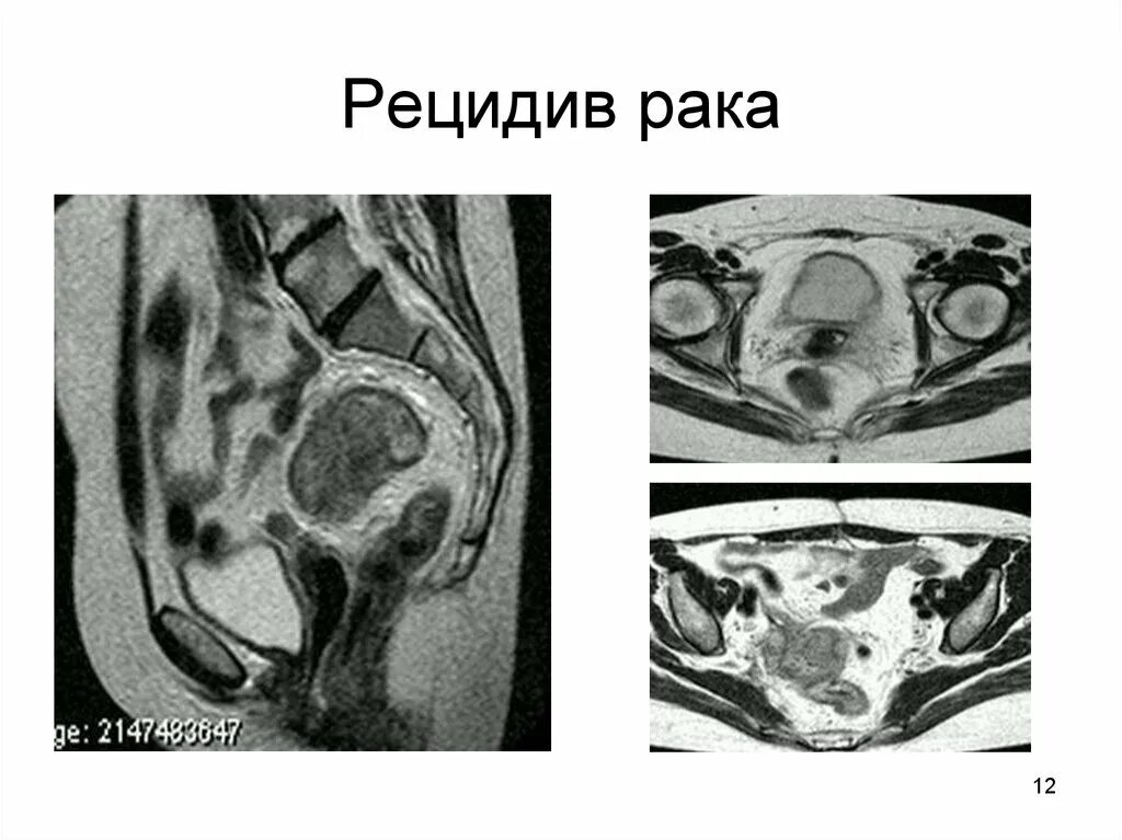 Рецидивирование опухоли. Рецидивирование опухоли картинки. Рецидивирование это в онкологии.