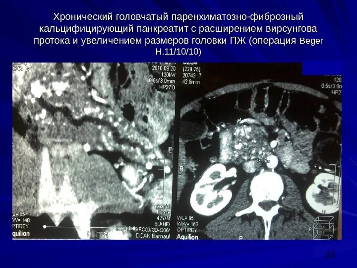 Кальцинозный панкреатит. Хронический калькулезный панкреатит кт. Хронический кальцифицирующий панкреатит. Хронический калькулезный кальцифицирующий панкреатит. Фиброзные изменения поджелудочной железы