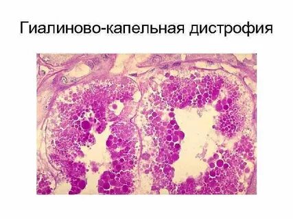 Белковая дистрофия