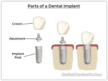 Des parts