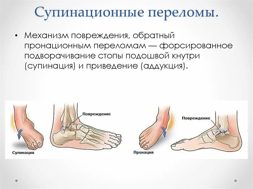 Супинационно-аддукционный перелом лодыжки. Переломы голеностопного сустава супинационные. Пронационные и супинационные переломы лодыжек. Растяжение, вывих голеностопа симптомы.