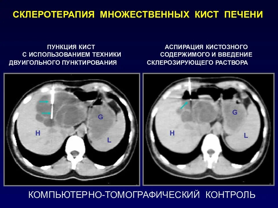 Паразитарная киста печени мрт. Кистозное образование печени