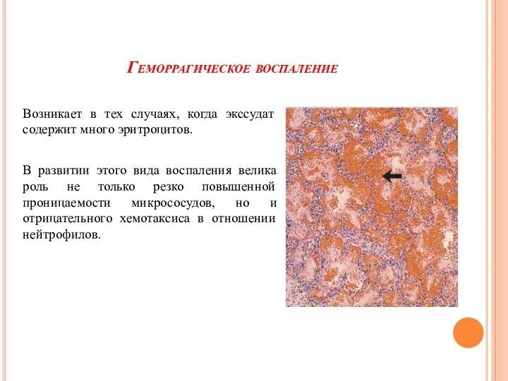 Появление экссудата характерно для