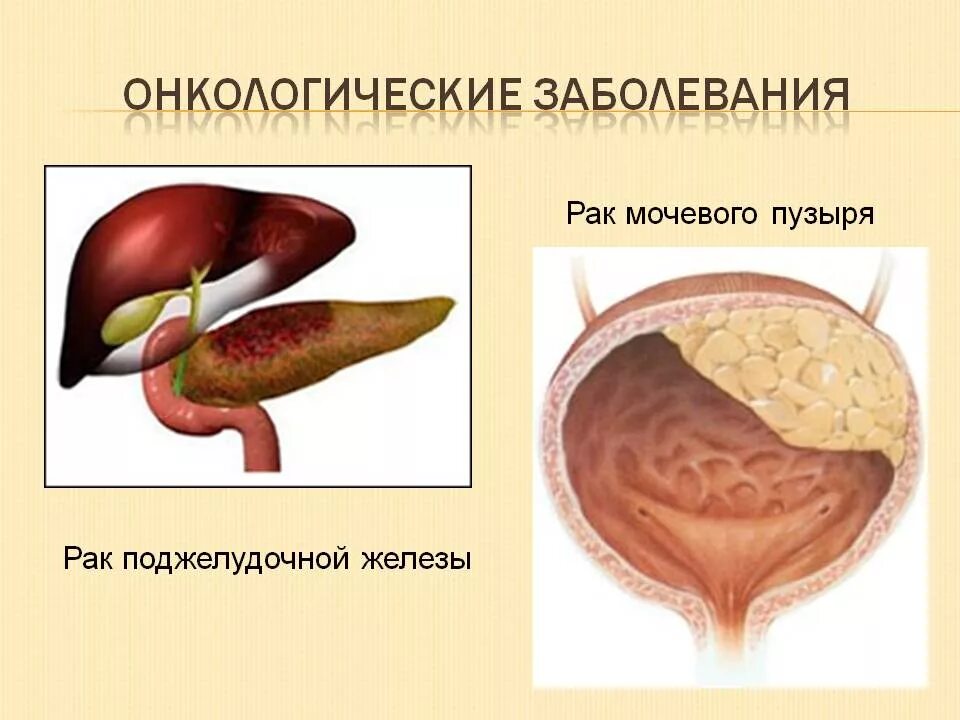 Рак суть болезни. Онкологические заболевания. Онкологические злокачественные патологии. Онкологические (раковые) заболевания. Онкологическим щаболеванием.