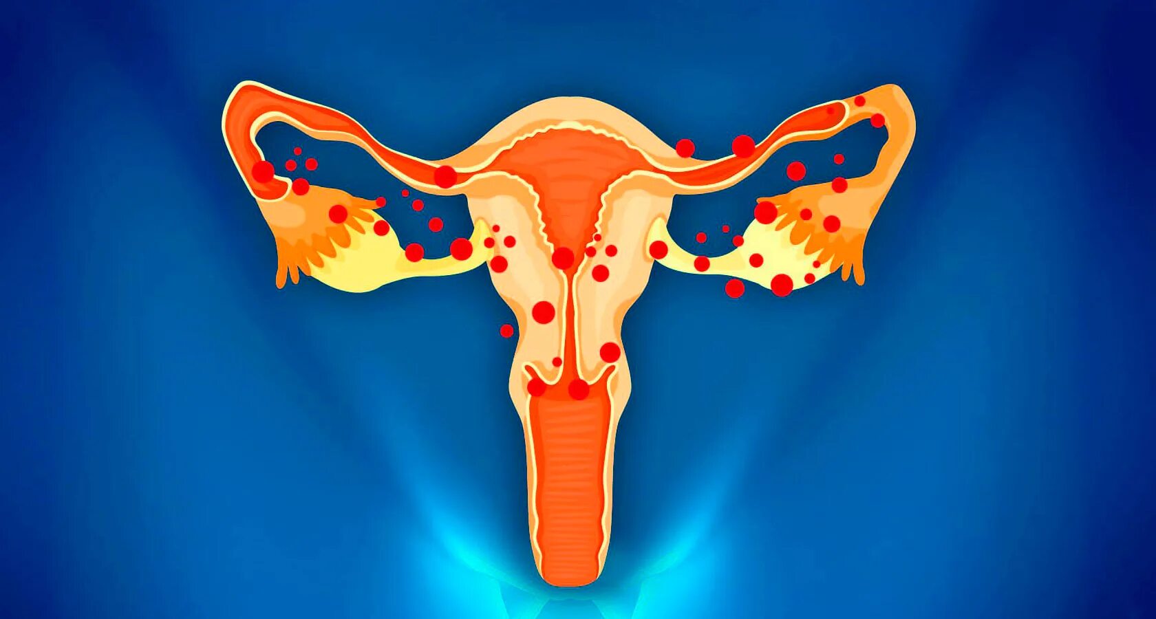 Внутреннее воспаление матки. Эндометриоз макропрепарат. Овариальный эндометриоз.