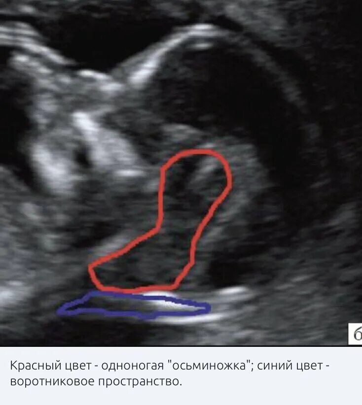 Узи аномалий. ТВП УЗИ 13 недель. УЗИ 16 17 недель носовая кость УЗИ. Скрининг УЗИ синдром Дауна. УЗИ скрининг ТВП.