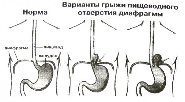 Диафрагмальный пищевода