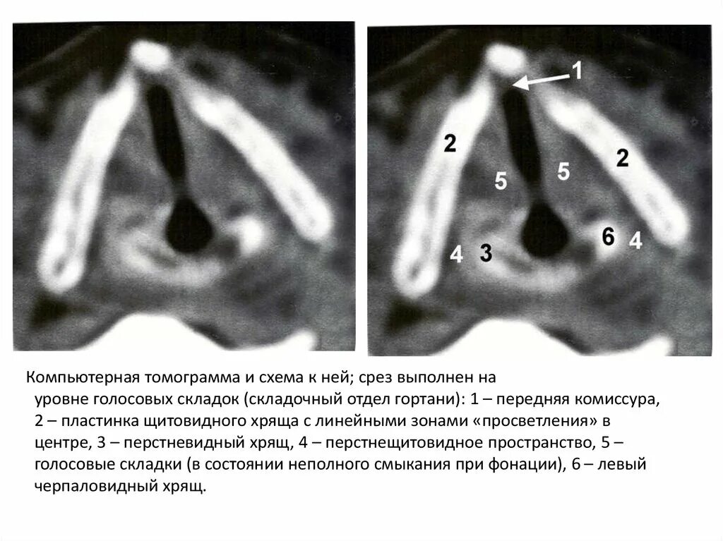 Laryngeal inlet - Wikipedia