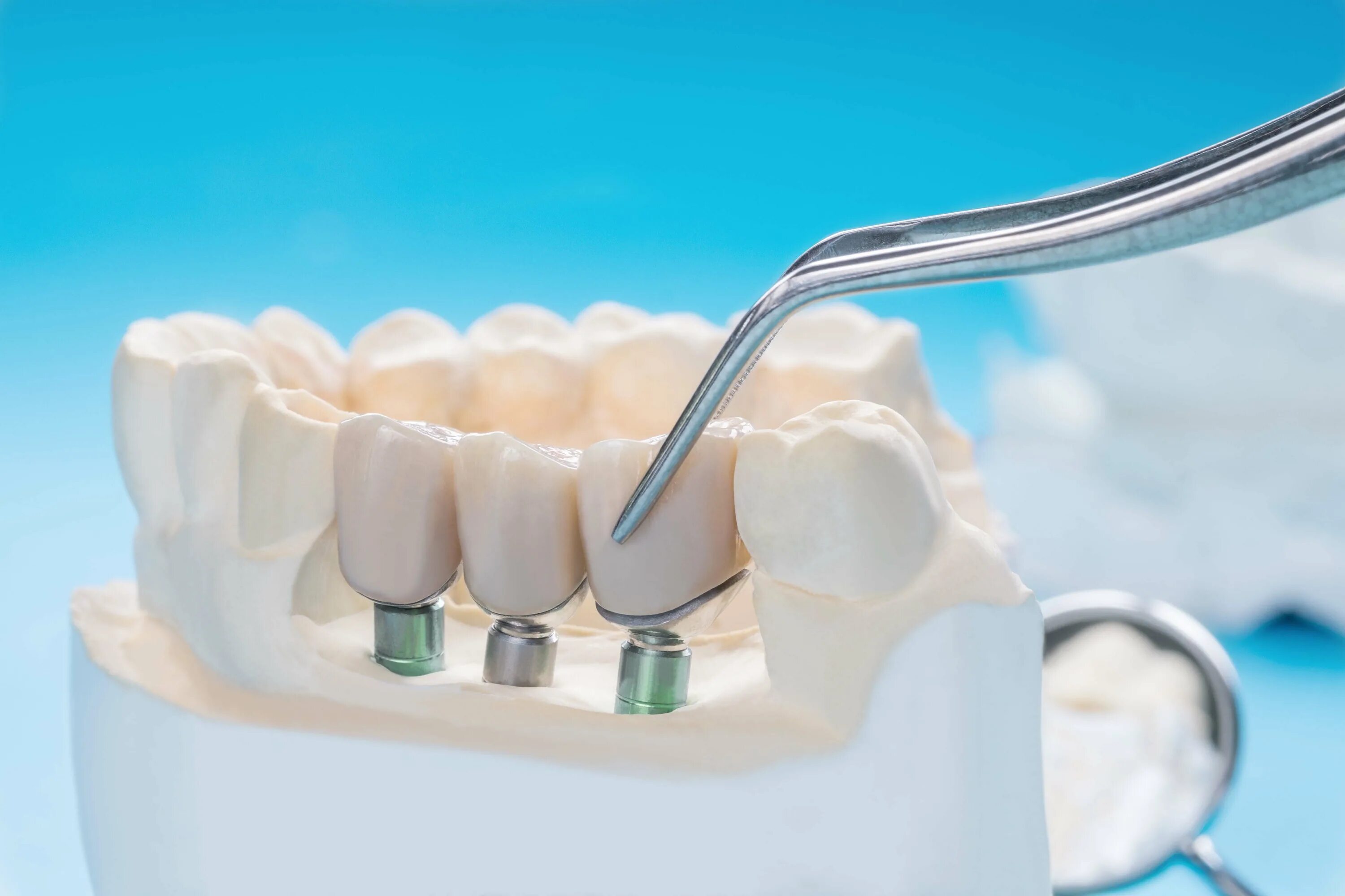 Имплантация зубов мостовидные протезы. Имплант стоматология. Стоматологические коронки. Красивые зубы стоматология. Врач протезист зубов