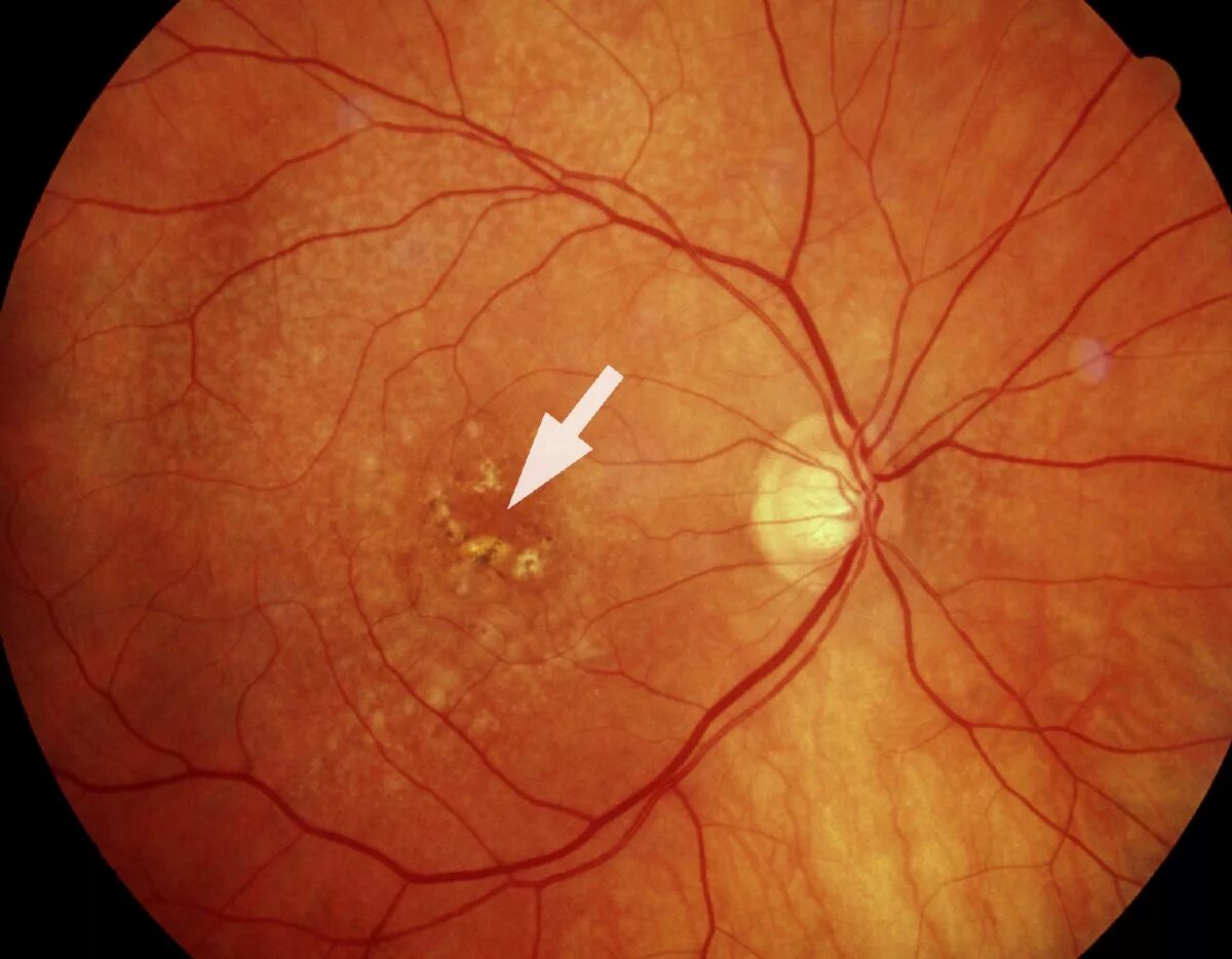 Макулодистрофия друзы. Макулярная дистрофия сетчатки глаза. Макулярная дегенерация. Центр сетчатки