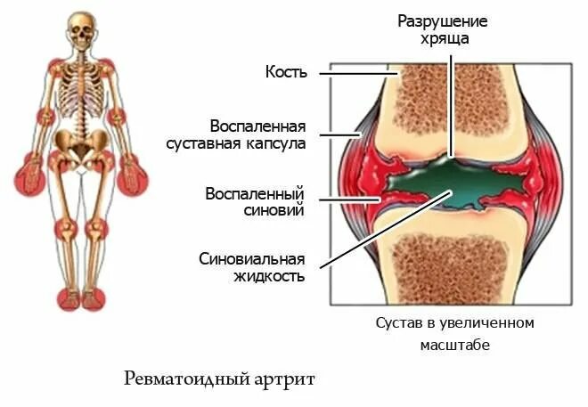 Костные инфекции (остеомиелит). Клетки красного костного мозга типы. Желтый костный мозг трубчатых костей. Костный мозг суставы. Красный костный мозг и желтый костный мозг.