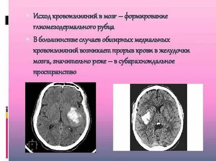 От чего происходит кровоизлияние