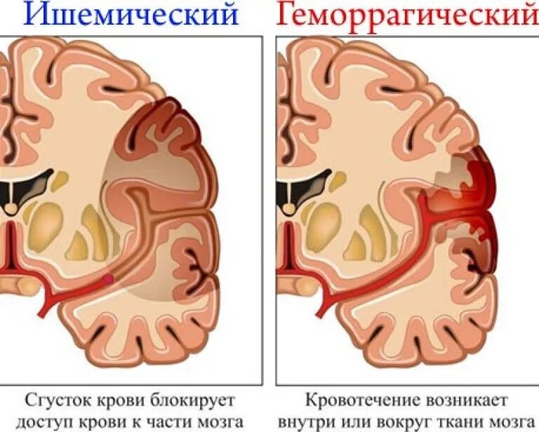 Что такое ишемический инсульт головного мозга. Вертебробазилярный бассейн инсульт ишемический. Инсульт мозга доли поражения. Ишемический инсульт препарат патологическая анатомия.
