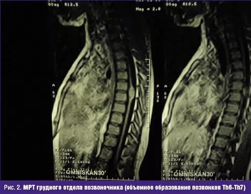 артериовенозные мальформации спинного мозга мрт.
