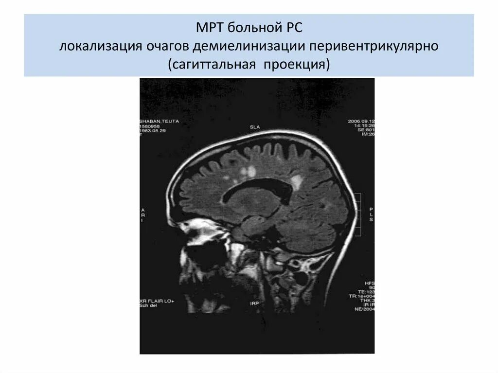 Демиелинизация головного. Очаги демиелинизации на кт. Демиелинизация на мрт рассеянный склероз. Демиелинизация головного мозга мрт. Демиелинизирующий процесс головного мозга что это такое.