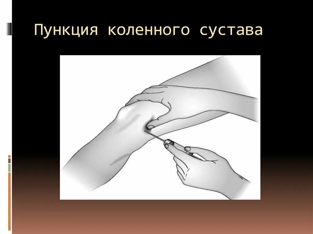 Непрерывистая вибрация пунктирование. Плевральная пункция гидроторакс. Плевральная пункция ход операции. Нейрохирургия пункция. Тонкоигольная аспирационная биопсия.