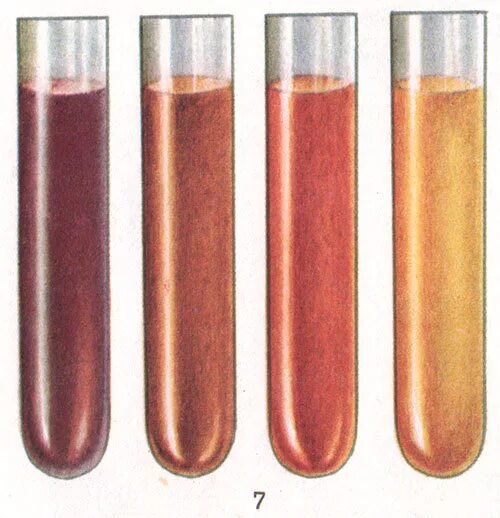 Гемоглобинурия и миоглобинурия. Маршевая гемоглобинурия. Гемолиз в пробирке. Гемоглобинурия в моче. Реакция на гемоглобин в моче