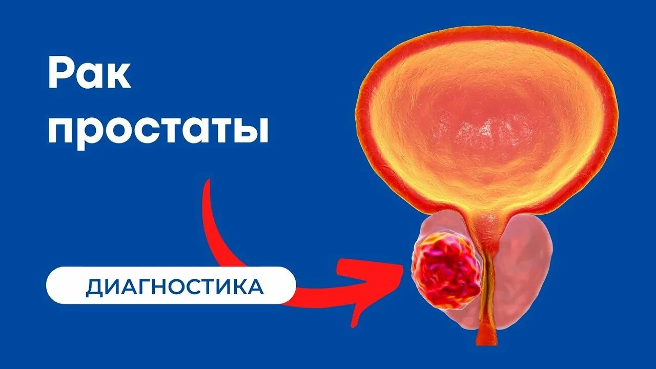 Диагностика простатита. Резекция опухоли предстательной железы. Рак предстательной москва