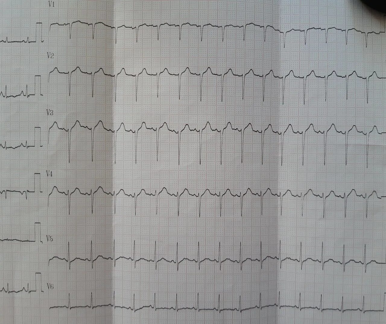 Патология QRS на ЭКГ. ЭКГ p100. Патологии ЭКГ на кардиограмме. Vc200 ECG-ЭКГ. Экг сочи