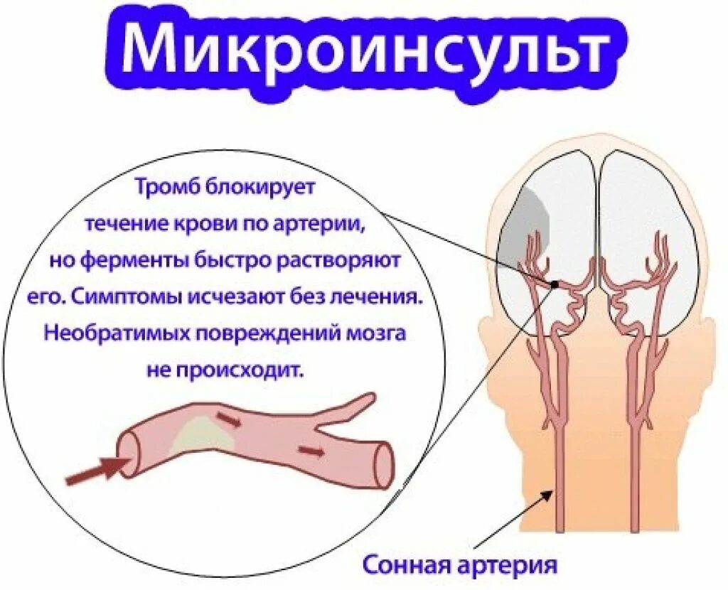 Инсульт микроинсульт