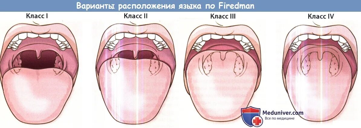 Неправильное расположение языка. Правильное расположение языка во рту. Положение языка во рту в норме. Положение языка в ротовой полости. Язык во рту в спокойном состоянии