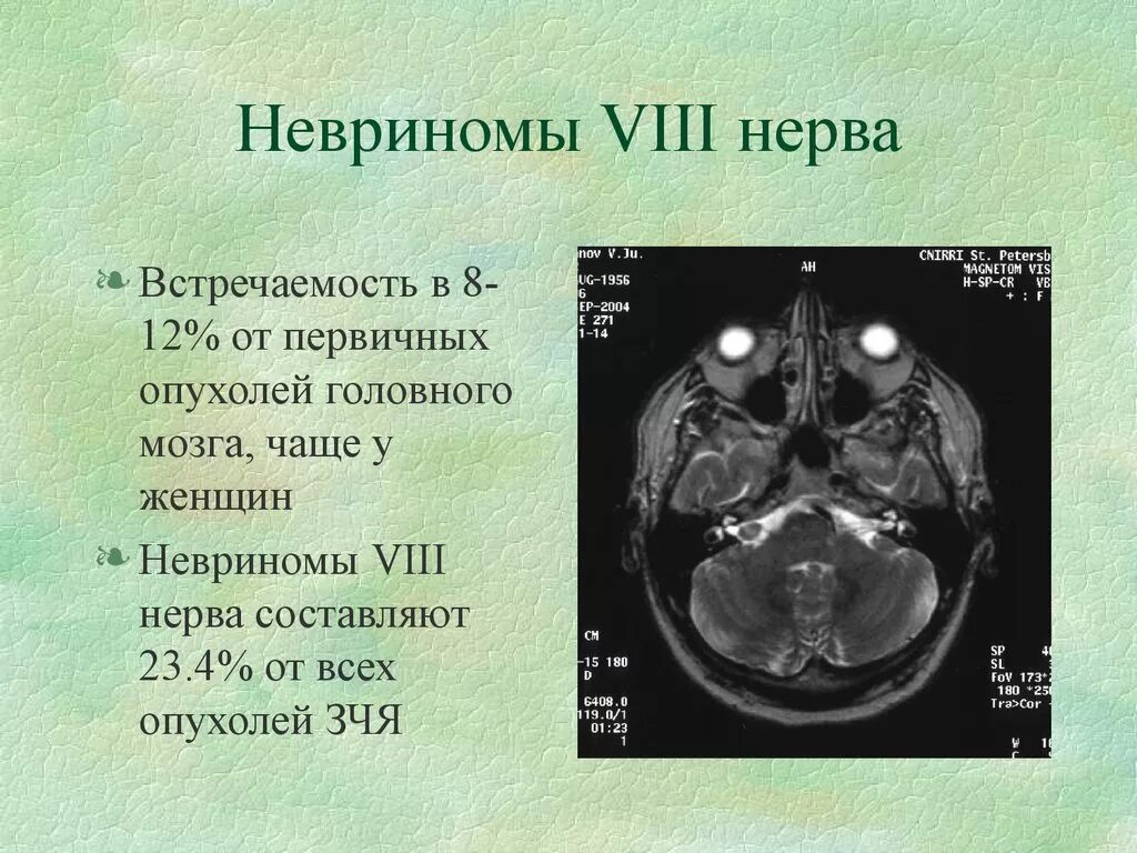 Мрт черепных нервов. Мрт черепно-мозговых нервов (ЧМН). Невринома слухового нерва мрт. Невриномы 8 пары черепных нервов мрт. Шваннома слухового нерва мрт.