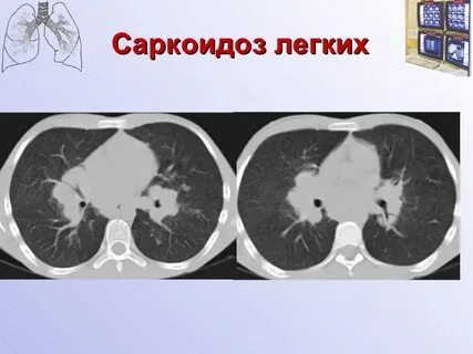 Саркоидоз кт