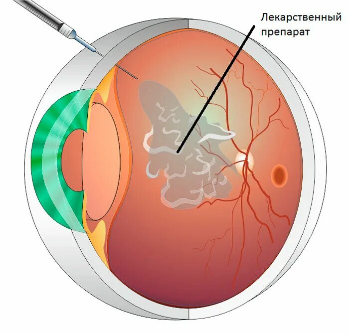 Интравитреальная инъекция. Диабетическая ретинопатия. Диабетическая ретинопатия глаз. Стекловидное тело ретинопатия. Интравитреальное Введение Луцентиса.