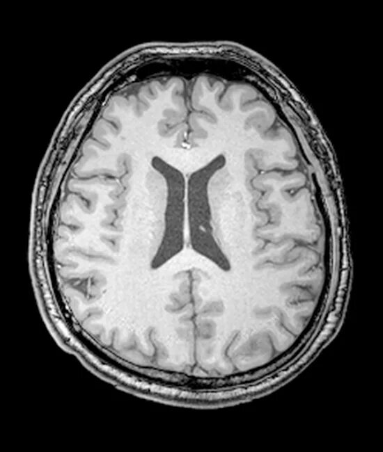 Мрт желудочков головного мозга в норме. Асимметрия боковых желудочков мрт. Боковые желудочки головного мозга на мрт. Асимметрия боковых желудочков на кт.
