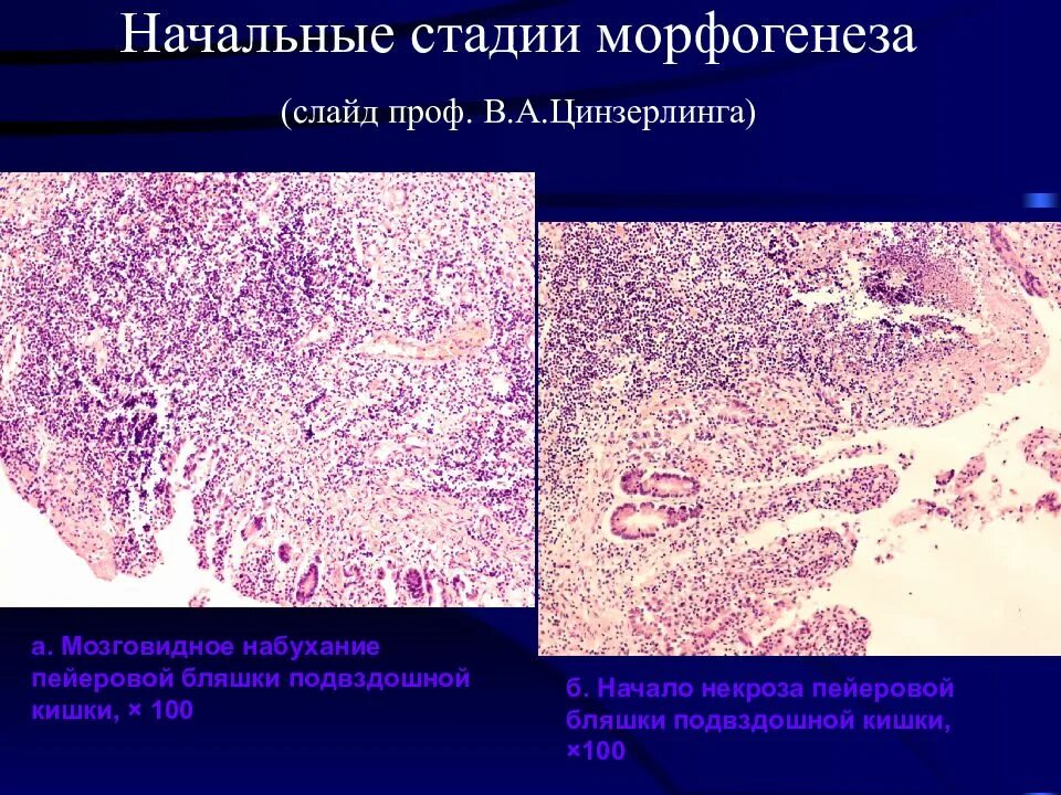 Сыпной тиф патанатомия. Сифилитическая гумма гистология. Гранулематозное воспаление. Коли инфекция этиология. Кишечные инфекции патологическая анатомия.