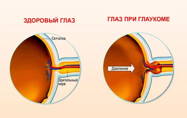 Глазное давление глаукома. Внутриглазное давление глаза.