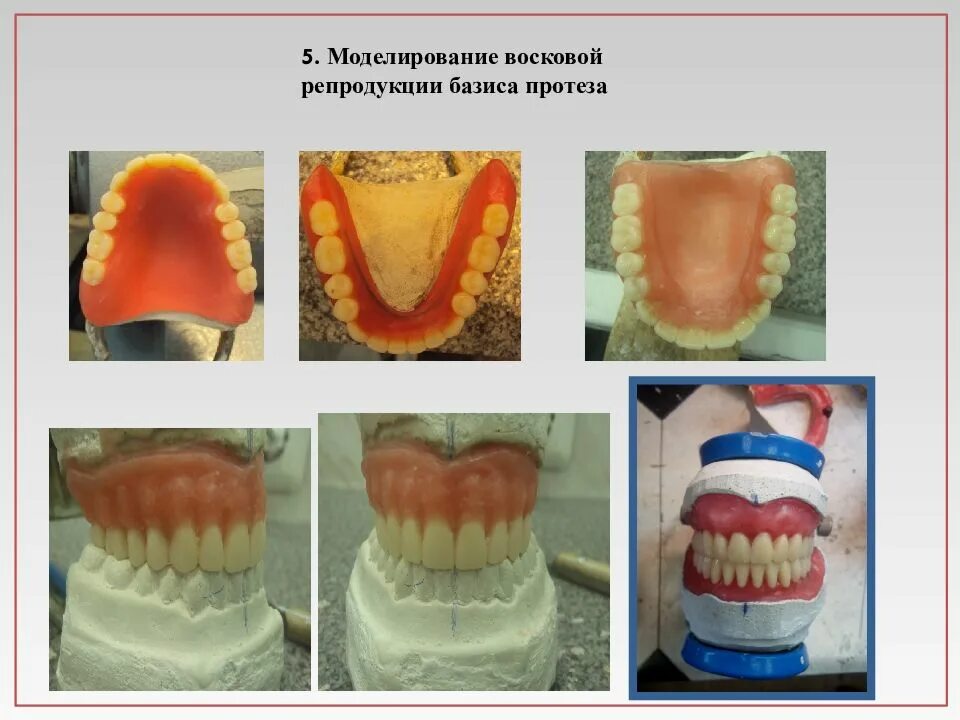 Моделировка базиса протеза. Моделировка базиса верхней челюсти. Восковые композиции в ортопедической стоматологии. Моделировка протеза из воска.