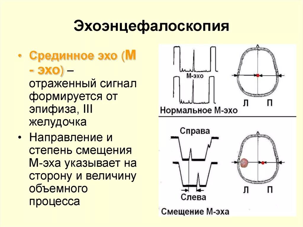 Просто эхо. Эхо ЭГ показатели нормы. Эхоэнцефалография. Эхоэнцефалография норма. Эхоэнцефалоскопия (м-Эхо).