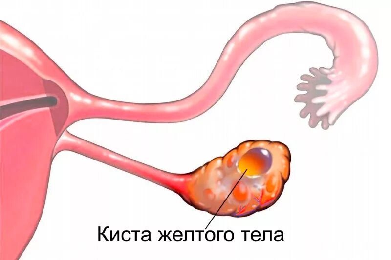 Киста желтого яичника при беременности. Жёлтое тело в яичнике на узи. Киста желтого яичника при беременности. Фолликулярная киста яичника на узи. Киста желтого яичника при беременности.